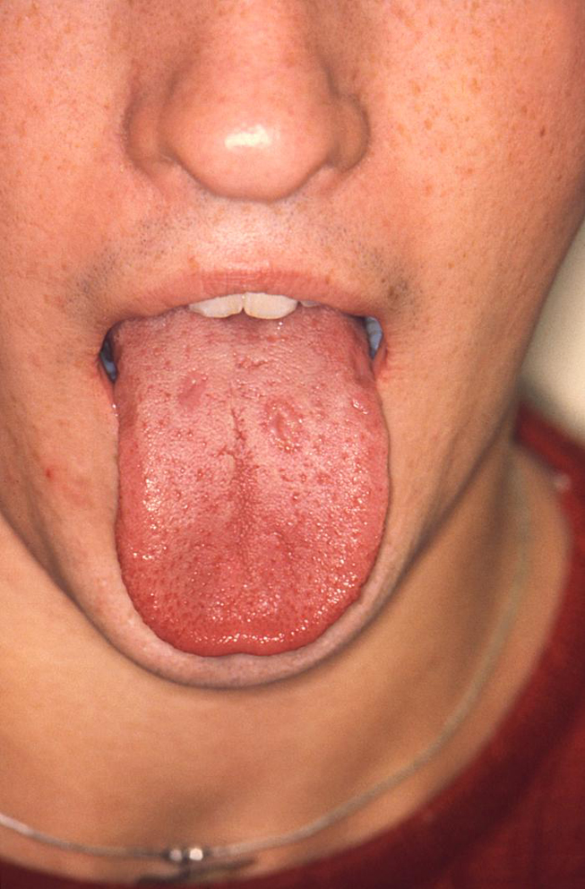 chlamydia mouth sores
