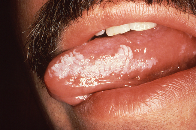 Course Content - #54072: Oral Manifestations of Sexually Transmitted  Infections - NetCE