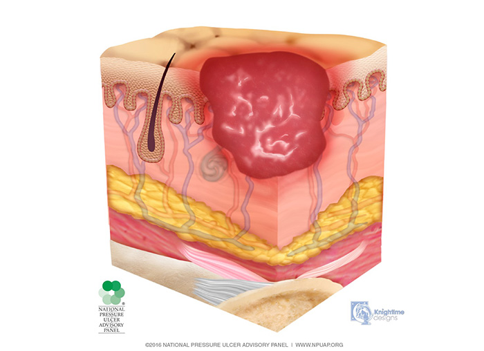 Care Chairs for Pressure Ulcer Management