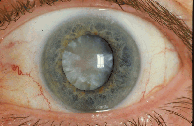 Course Content - #90564: Disorders and Injuries of the Eye and Eyelid -  NetCE